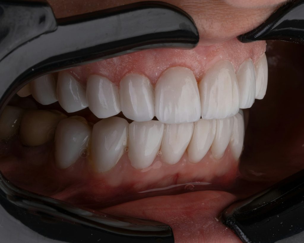 teeth whitening procedure bright white smile