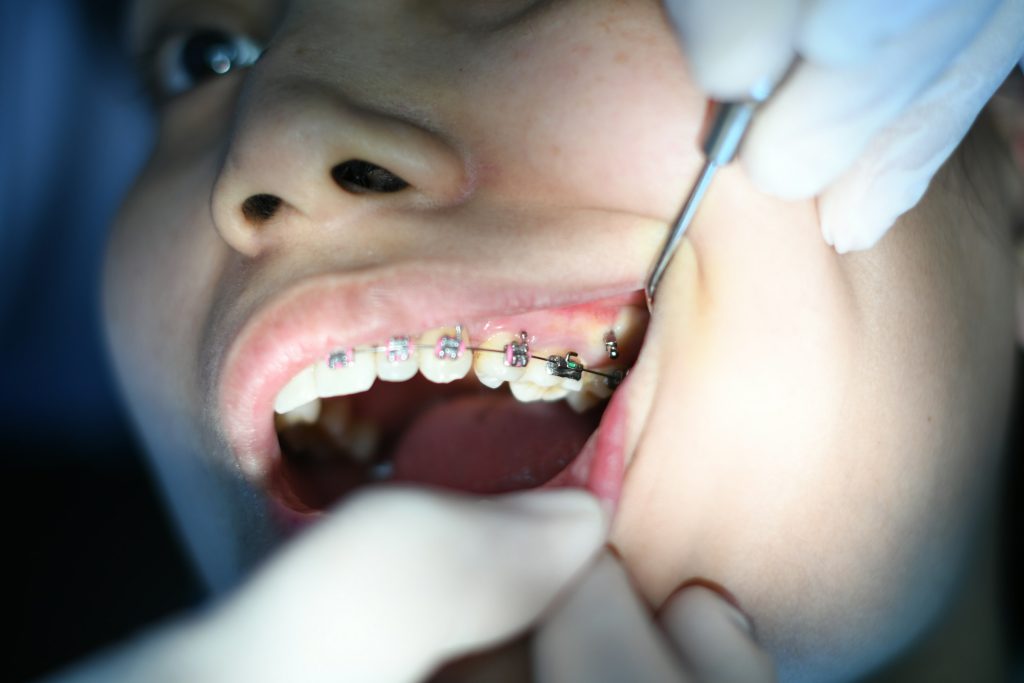 braces fixed orthodontic metal teeth close up