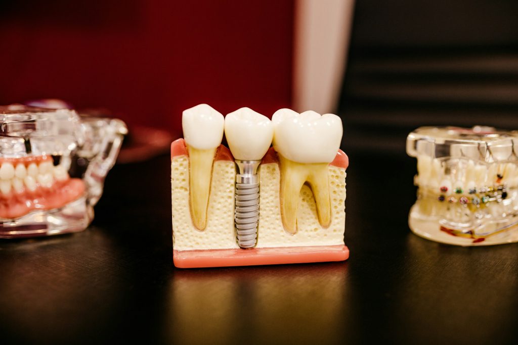 “zubni implant titanium”